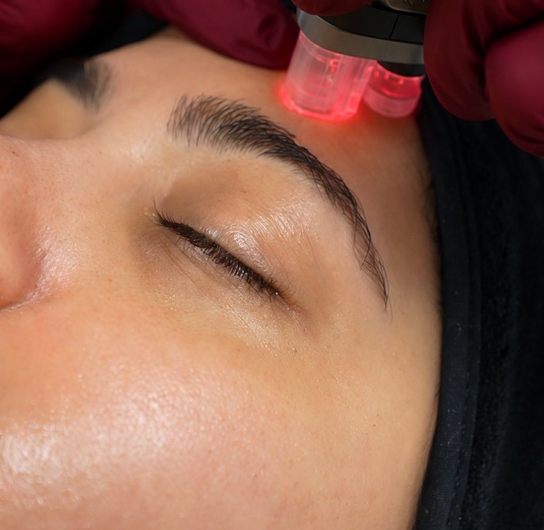 Microneedling процедура отблизо
